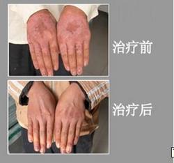 牛皮癣病因