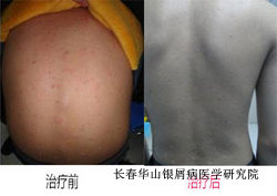 银屑病症状