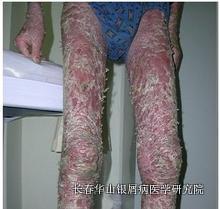 银屑病症状