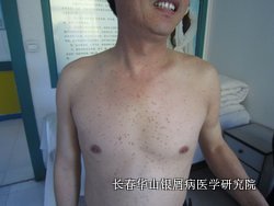 银屑病症状