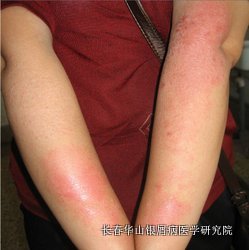 银屑病症状