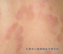 银屑病症状