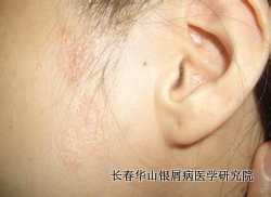 银屑病症状
