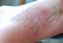 长春医大一院皮肤科在线咨询