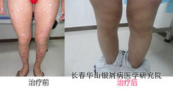 银屑病治疗