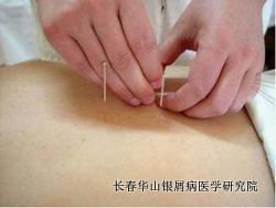 银屑病治疗