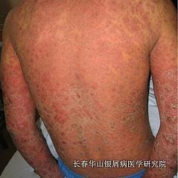 银屑病症状