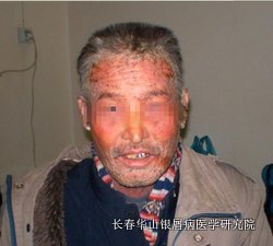 银屑病症状